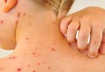 Campak Jauh Lebih Menular dari Covid-19